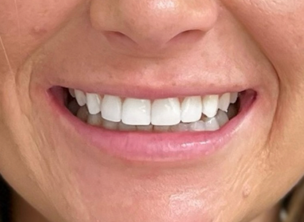 ترميم الأسنان بالكومبوزيت