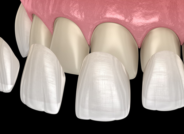 قشور الأسنان (الفينيرز)